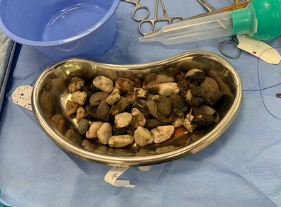 The 1.2kg stones surgically removed from Luna's stomach.