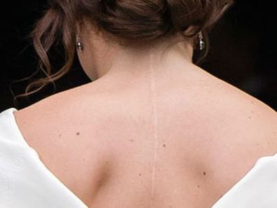 Princess Eugenie on showing scoliosis scar at wedding