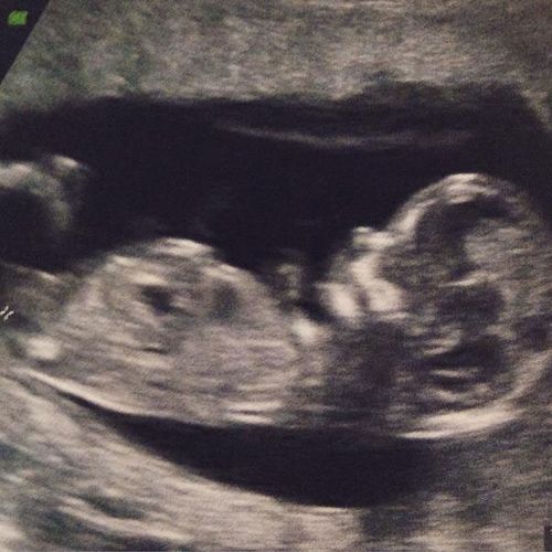 An ultrasound photo posted on Libby Trickett's Twitter account. (supplied)