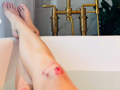 Katy Perry posts knee injury photo after faceplant on stage during Lifetimes Tour show