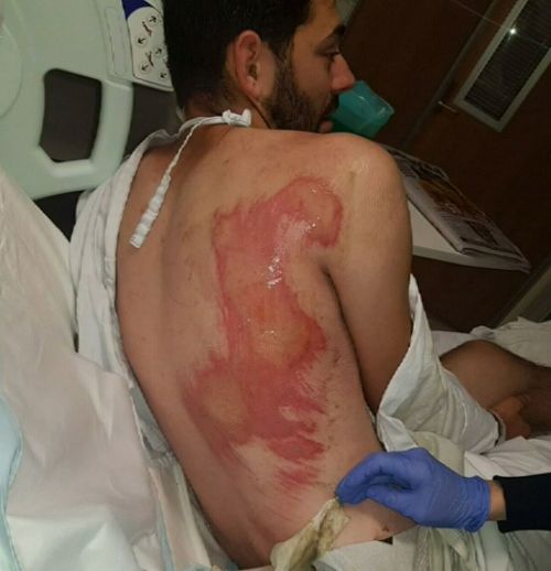 Mr Cotter's badly grazed back. Picture: 9NEWS