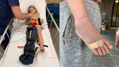 Left: Toddler lying in hospital bed with splint on her left leg. Right: close up of snake bite with markings and bandage on top.
