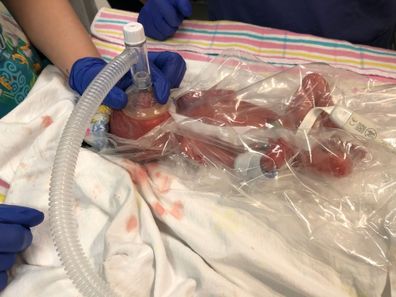 Premature baby Rafferty in humidcrib with oxygen mask and plastic cover at the Mater Mothers' Hospital in Brisbane