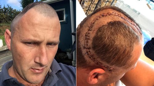 Benjamin Lightbody has endured five operations to replace a large piece of his skull with an implant. Because of the implant's size, he has suffered a variety of complications and ongoing pain. (Supplied)