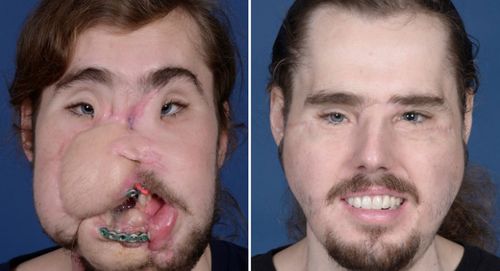 The time between injury and face transplant was 18 months, the shortest period between the two in US face transplant history.