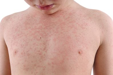 Boy with measles