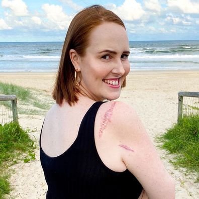 Skin cancer survivor Courtney Mangan shows the scars on her arm.