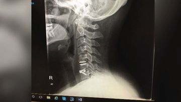 An MRI revealed a large disc protrusion in Katrina Dargie&#x27;s neck that had herniated. 