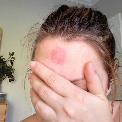 Sydney mum Nikki Smith reveals hilarious 'suction cup hickey' from kids toy.