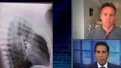 Chris Cuomo shares shot of chest X-Ray