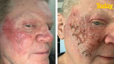 Paul 'Fatty' Vautin was able to treat his skin cancer with non-invasive treatment, described as 'chemotherapy in a tube'.