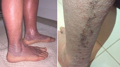 Her feet turned purple, discolouration and scaly raw skin formed cracks down her legs.
