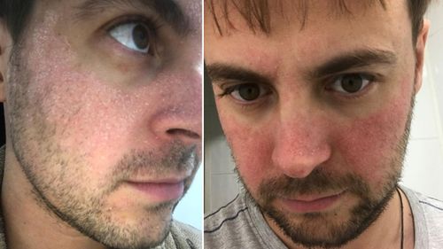 Will says having a very visible facial skin condition affected him far beyond any physical discomfort.