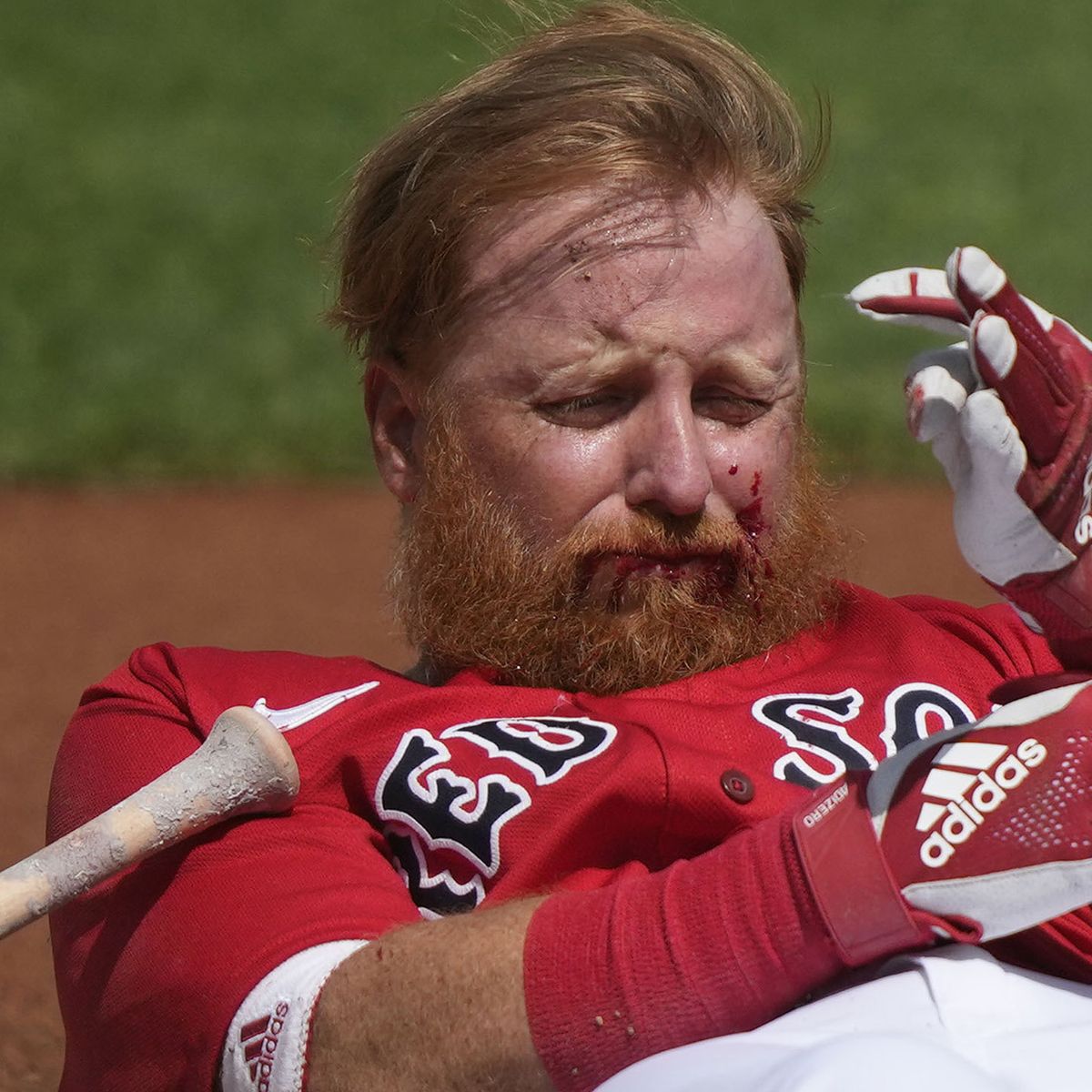 Boston Red Sox third baseman Justin Turner receives 16 stitches