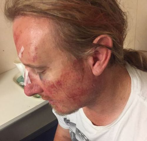 Anthony Titlow was left with multiple facial fractures after the brawl broke out. (Supplied)