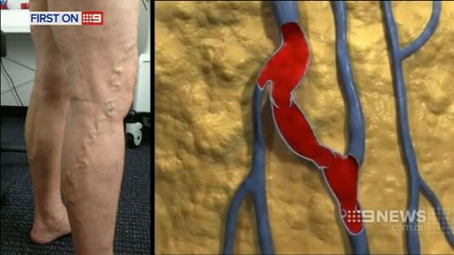 Varicose veins occur when veins lose elasticity. (9NEWS)