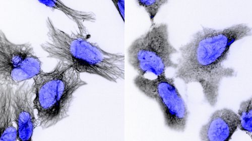 Neuroblastoma is a deadly cancer that can affect children as young as two-years-old. A new study by the Garvan Institute may have found a drug that can help cure it.