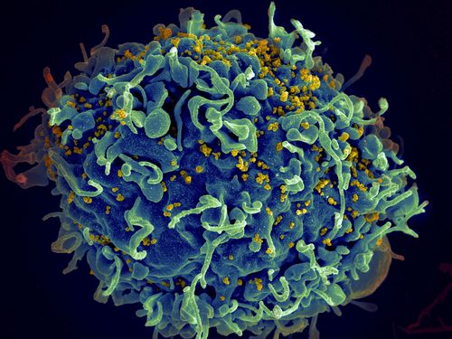 A scan shows a human T cell, in blue, under attack by HIV, in yellow, the virus that causes AIDS. The virus specifically targets T cells, which play a critical role in the body's immune response against invaders like bacteria and viruses.