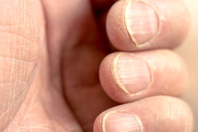 Brittle
fingernails