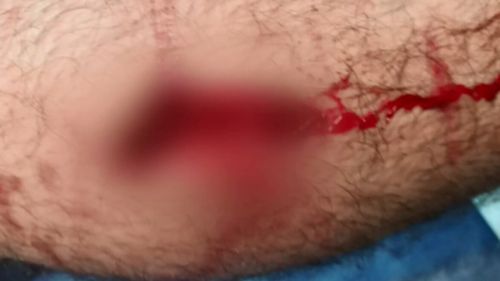 The 19-year-old suffered severe bite wounds to his calf. (9NEWS)
