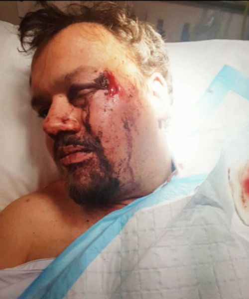 Jesse Lee was left with a fractured eye socket, cheek bone and temple. Picture: 9NEWS