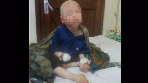Albino boy's hand hacked off for witchcraft