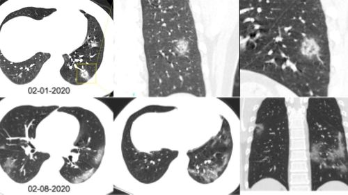 Chest CT scans of a 34-year-old man with coronavirus in China.