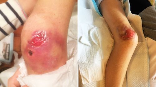 Ella's knee pictured before surgery and one month ago.