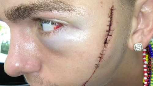 The 15-centimetre cut needed 17 stitches. Picture: GoFundMe