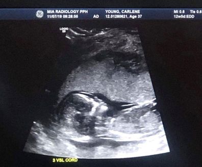 Premmie baby ultrasound
