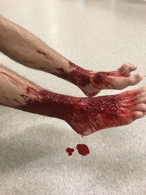 Sam Kanizay said his lower legs and feet were left with tiny pin pricks seeping blood. (Supplied)
