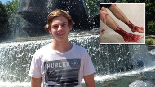 Sam Kanizay's feet started bleed after he walked out of the beach. (Facebook/Fairfax)