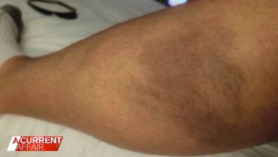 A bruise on Ben Murphy's leg.