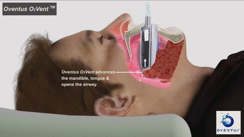 The device allows sleep apnoea sufferers to receive low-pressure airflow without facemasks.