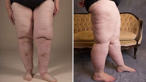 A photo showing the legs of Nola Young (left) and Cassie (right), who are both affected by lipoedema.