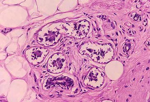 Immagine microscopica di melanoma maligno in un'ulcera pigmentata (MD Abul Hosen/Getty)