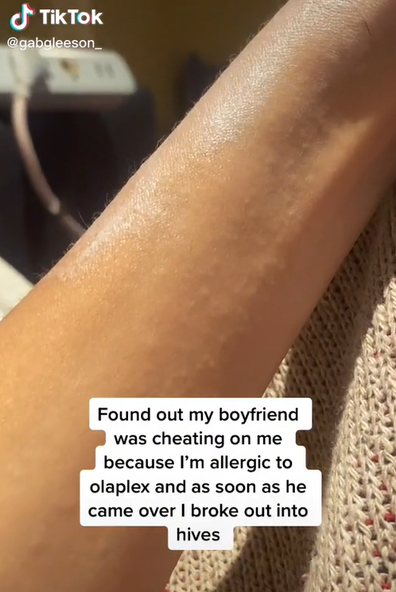 Boyfriend cheating sign rash hives