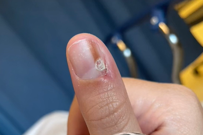 Skin cancer: Woman with 'cool' streak on nail discovers serious health  problem - 9Honey