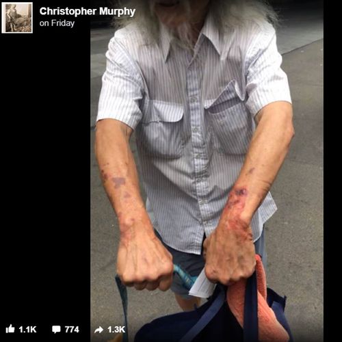 A photo purporting to show bruises on Danny Lim, shared on Facebook after his arrest.