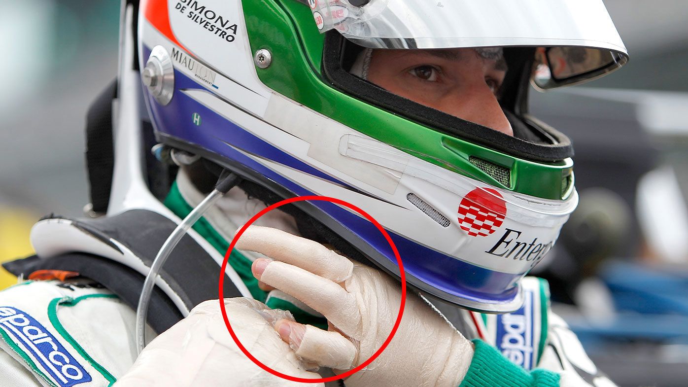 Simona de Silvestro pictured with her hands wrapped up just days after suffering horrific burns