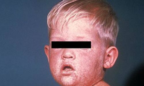 An example of a rash on the face from measles on day three. (Supplied: Vic Health Department via US Centers for Disease Control and Prevention)