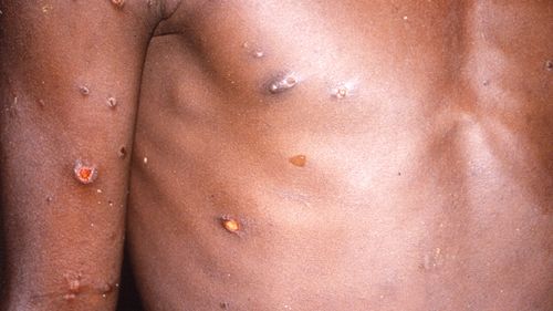 Monkeypox can be seen on a man's body