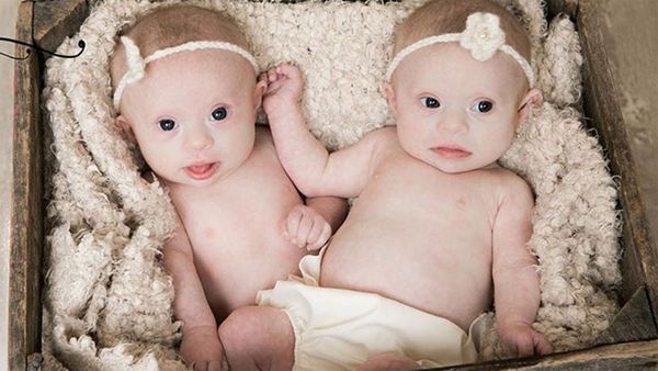 Down syndrome twins one in a million chance
