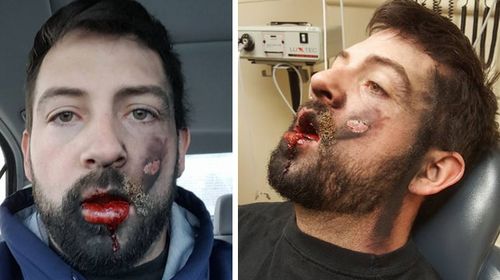 US man left with devastating injuries after e-cigarette explosion