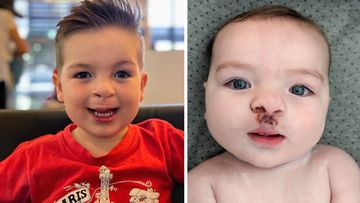 Tim Devlin&#x27;s son, Josh, has so far had three surgeries on his cleft lip and palate and is likely to undergo regular operations until he is 21.