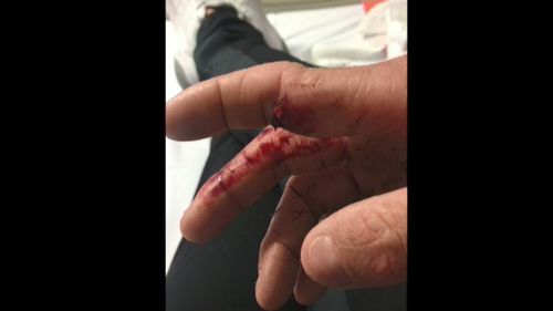 The NRL player posted a graphic photo of his fractured index finger, showing that the bone had pierced the skin. Picture: Instagram.