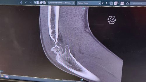 An x-ray of Kane Valenine's arm, where two thirds of the bone was worn away as it scraped along the road.