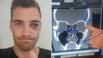 Bachelorette star 'may never feel his face' after one punch attack