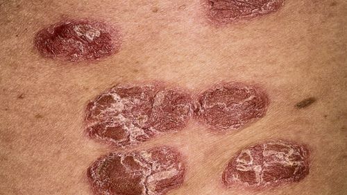 Fejbőr psoriasis kezelése ausztrália | Sanidex Magyarországon