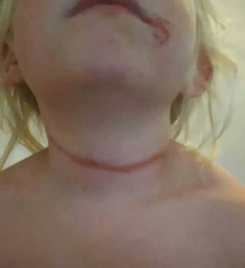 Marley Oster was left with a scar on her neck. (Supplied)